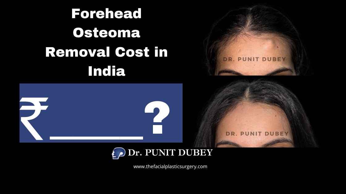 Forehead Osteoma Removal Cost in Delhi (2025) – Scarless Endoscopic & Traditional Methods by Dr. Punit Dubey