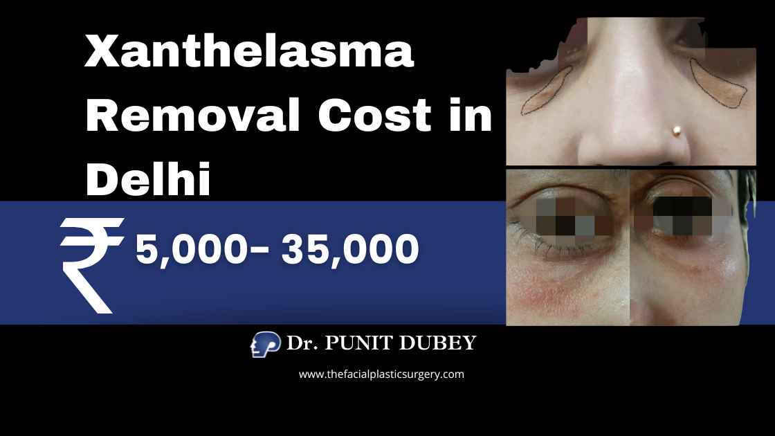 Xanthelasma Removal Cost in India by Dr. Punit Dubey – 2025 Pricing Guide