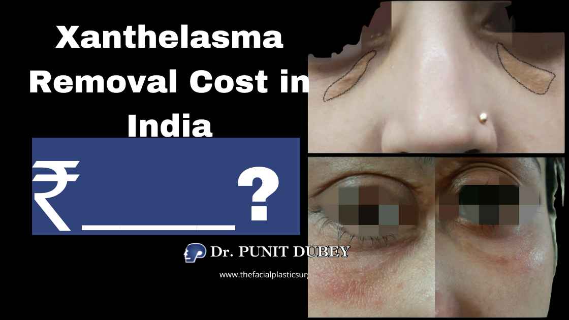Xanthelasma removal cost in Delhi – eyelid cholesterol deposit excision 2025 by Dr. Punit Dubey