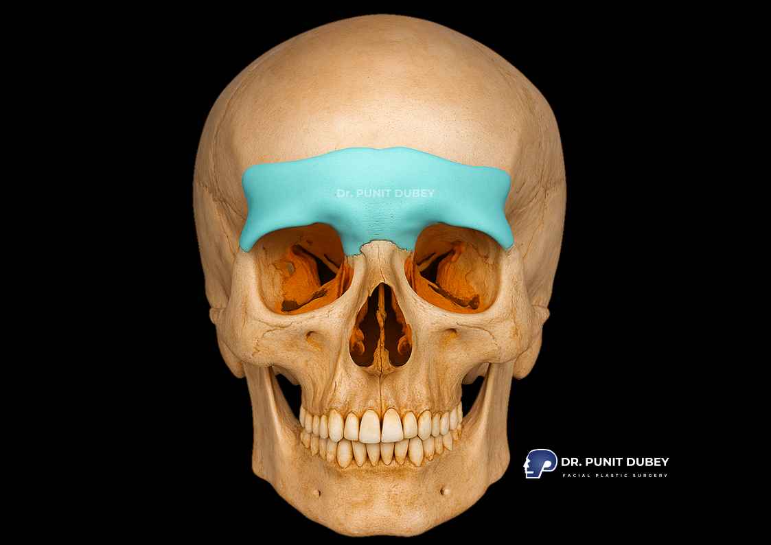 Forehead augmentation surgery in India with forehead implants, enhancing facial balance with expert care.