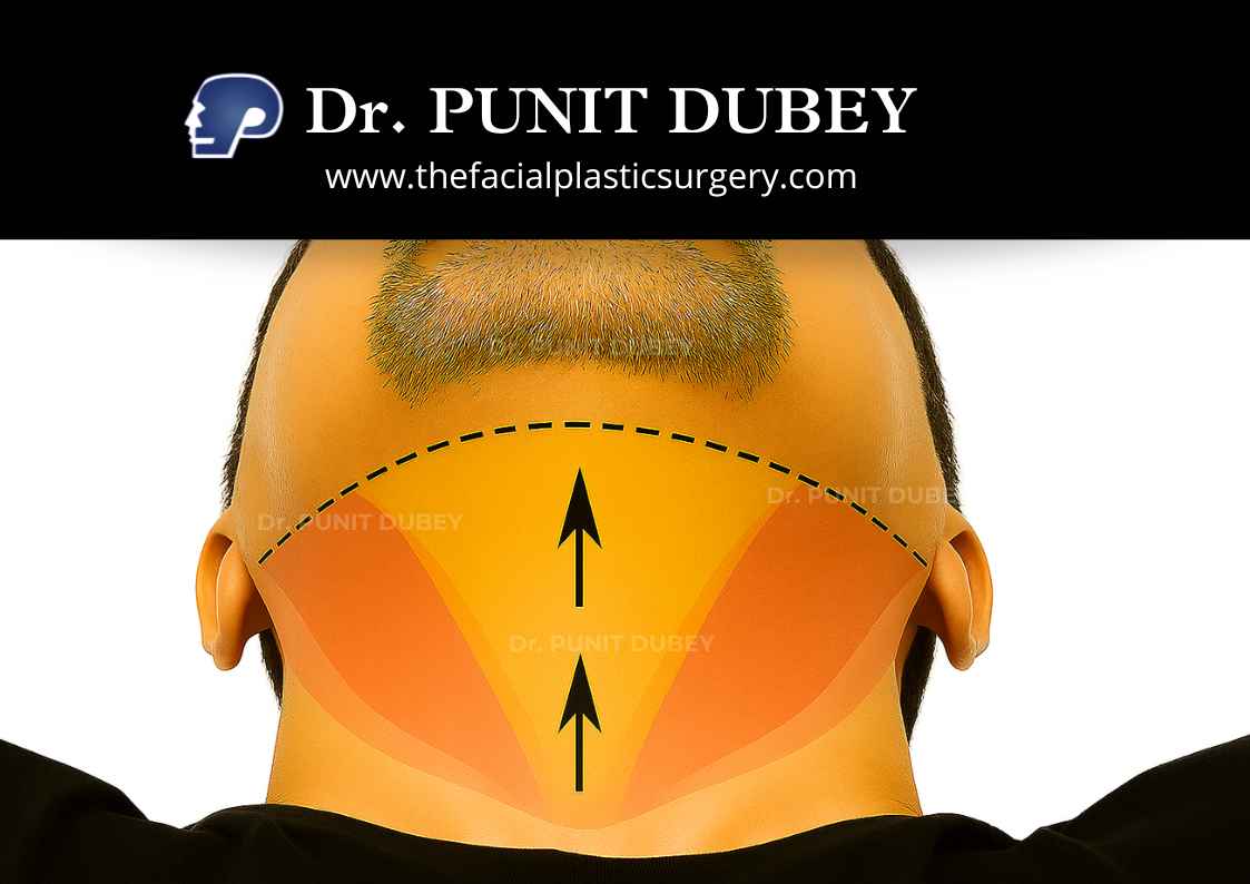 Deep Plane Neck Lift Surgery – Definition and Benefits