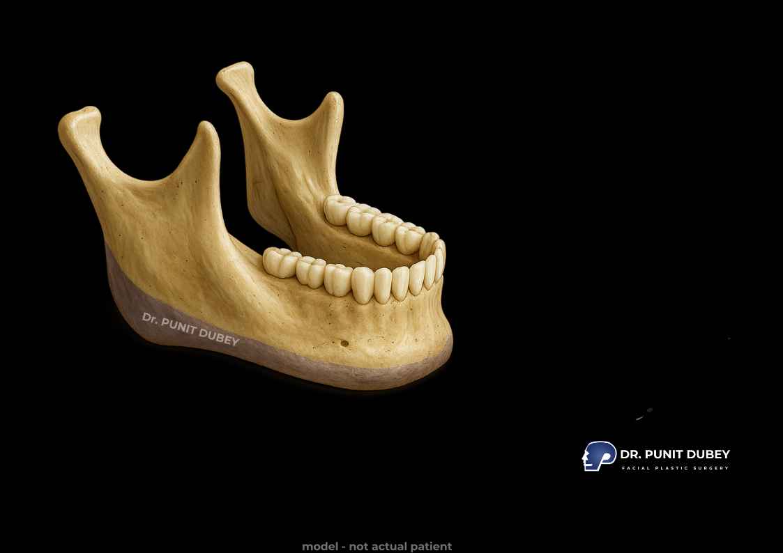 What is V Line jaw surgery? A procedure to create a sharper, V-shaped jawline for enhanced facial balance.