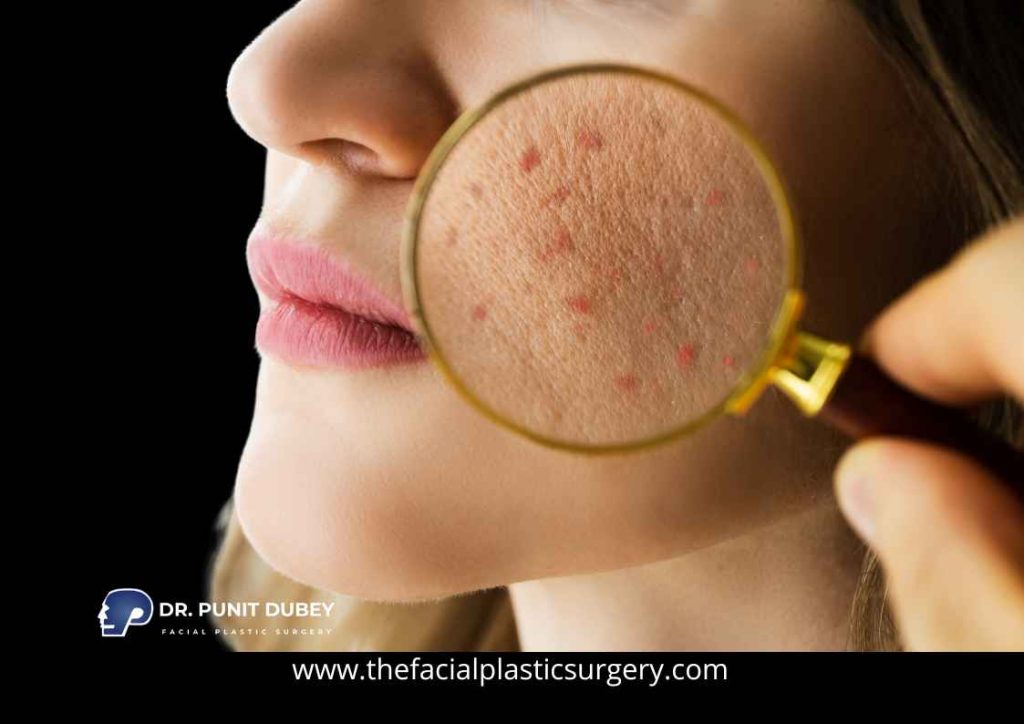 Acne Scar Treatment in Delhi by Dr. Punit Dubey - Smooth and Rejuvenate Your Skin