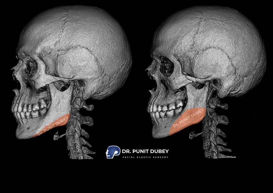 Jaw Reduction Surgery in Delhi by Dr. Punit Dubey - Sculpt a Defined Jawline