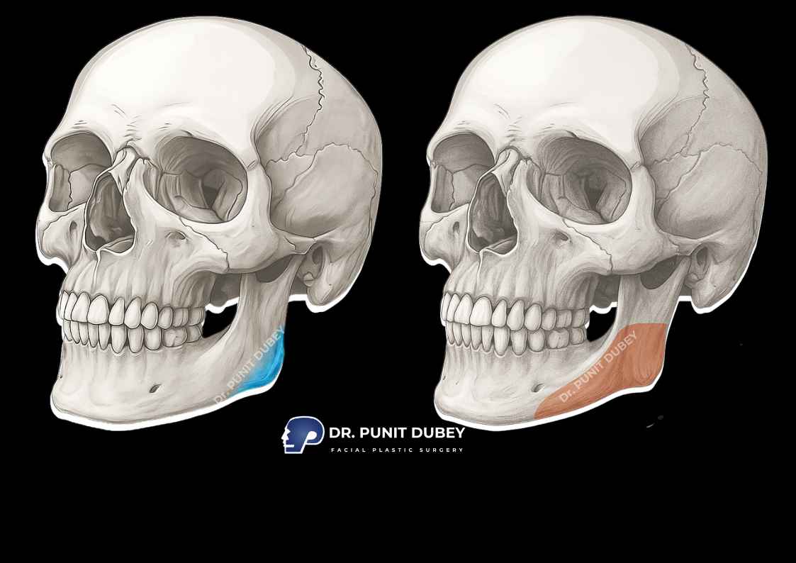 Jaw reduction surgery, reducing the jawline for a more refined and balanced facial profile.
