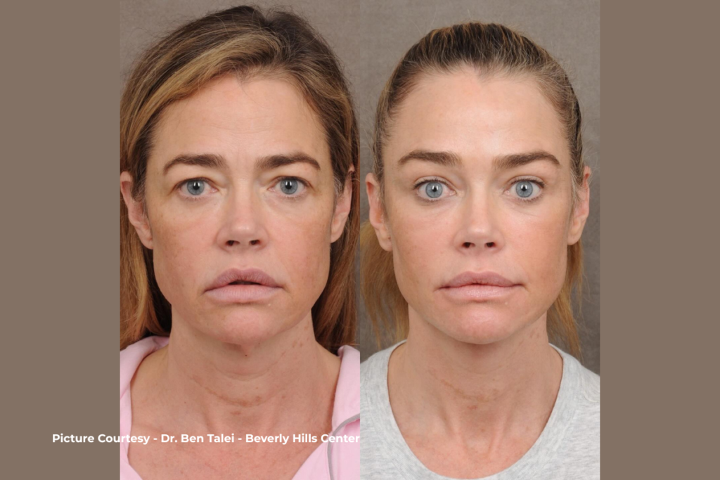 What Denise Richards really had done — comprehensive AuraLyft by Dr. Ben Talei with natural, undetectable results