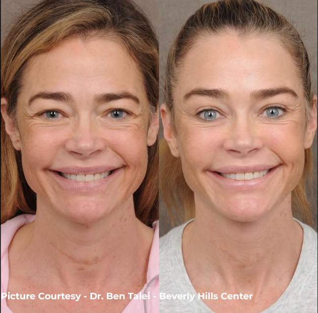 Denise Richards before and after deep plane facelift by Dr. Ben Talei showing natural facial rejuvenation