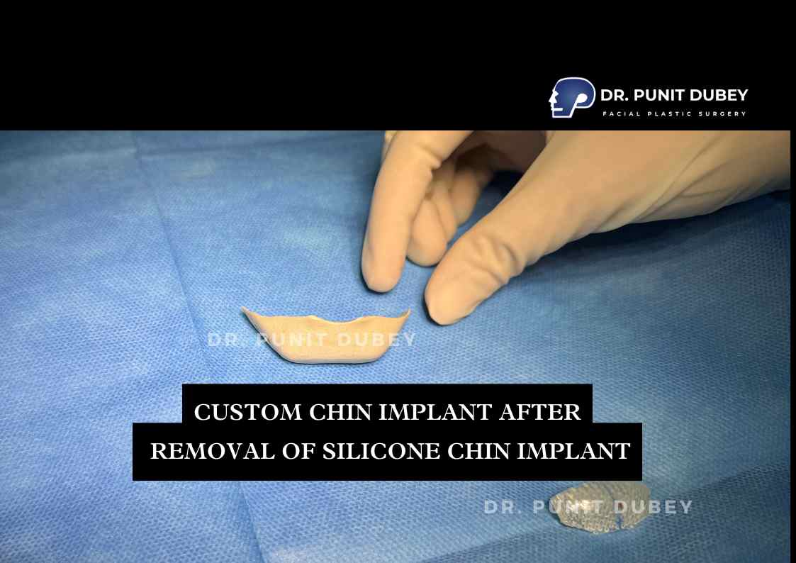 Best Chin Implant Surgeon in India - Dr. Punit Dubey
