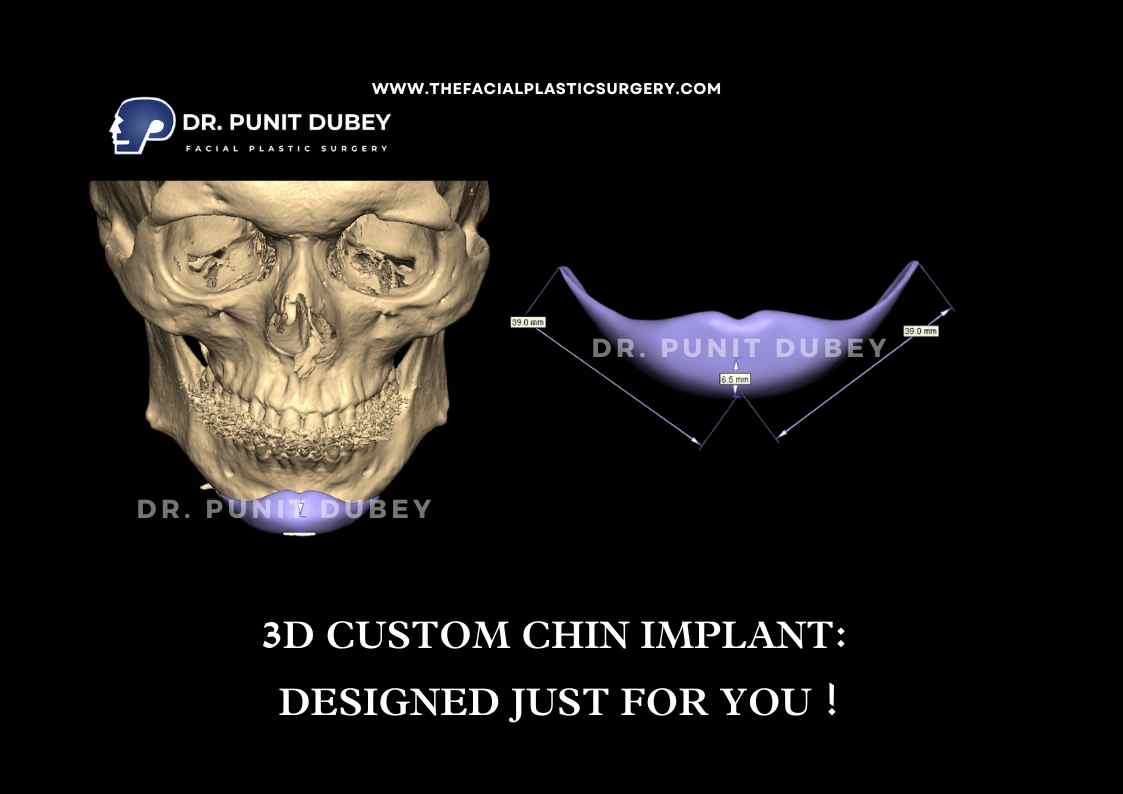 Chin implant before and after in Delhi by Dr. Punit Dubey