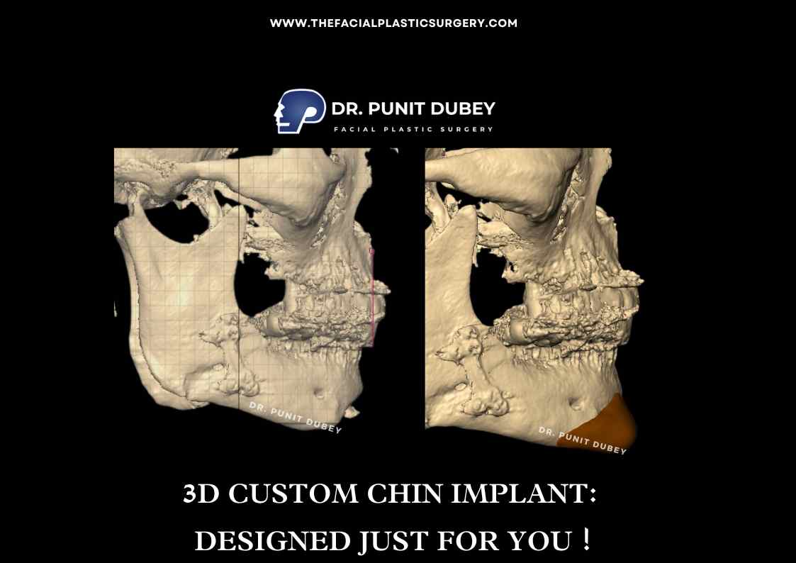 Custom Chin Implant in India by Dr. Punit Dubey - Precision Chin Enhancement