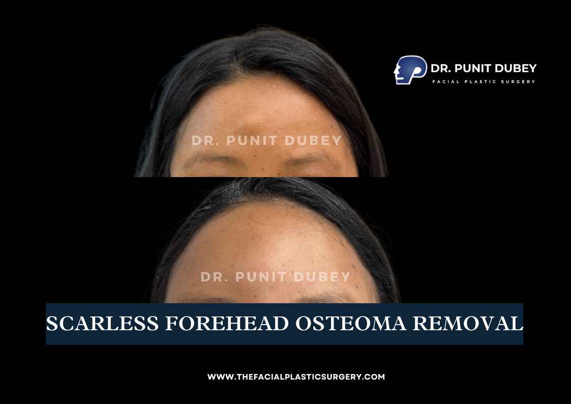 Osteoma forehead before and after in Delhi by Dr. Punit Dubey, showing a smoother and more refined forehead contour.