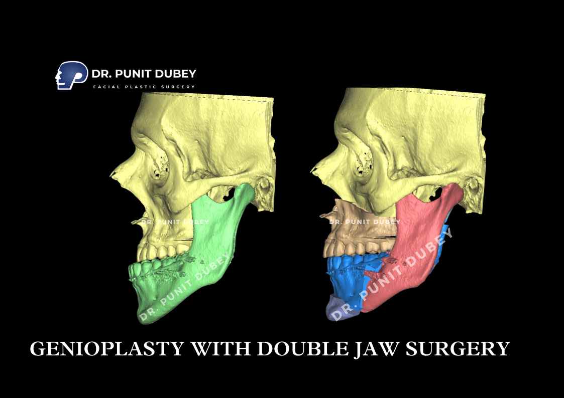 Genioplasty Before and After in Delhi by Dr. Punit Dubey
