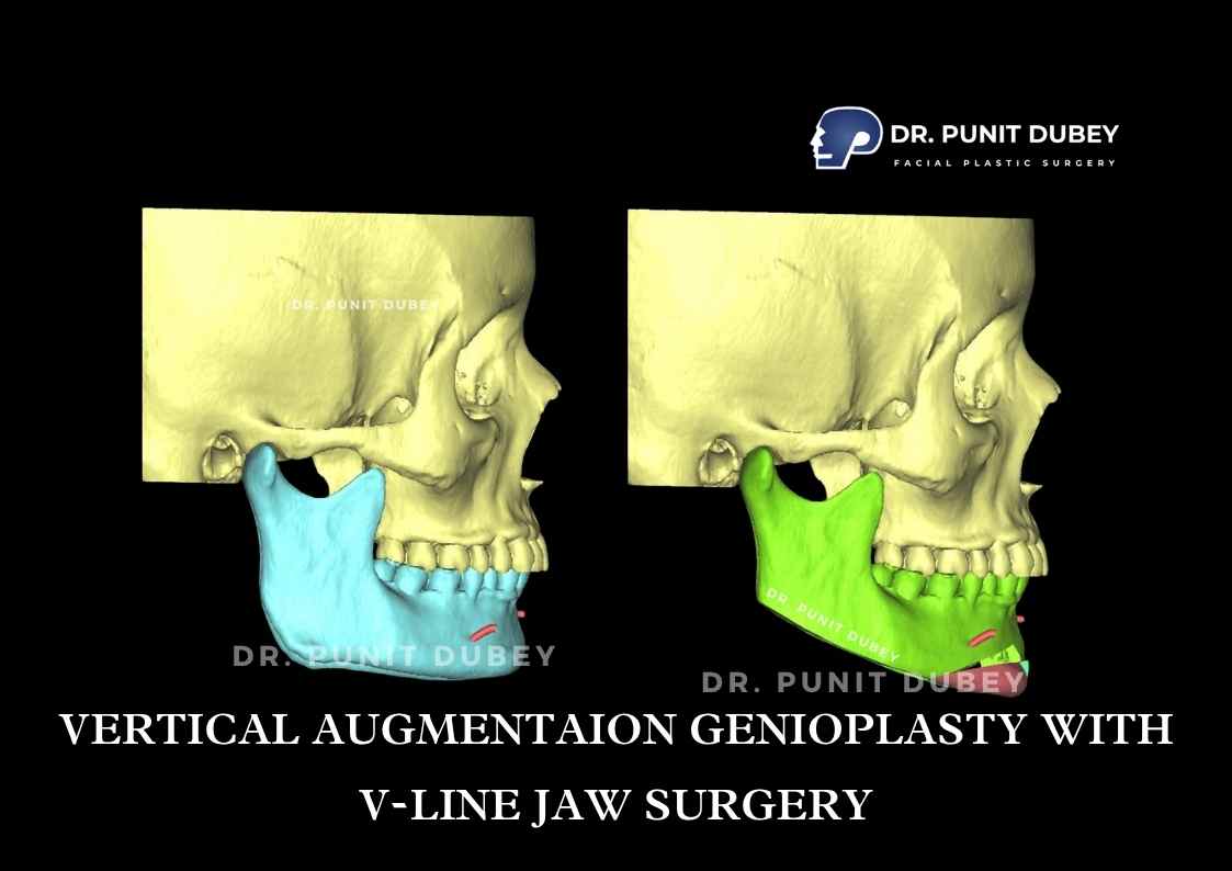 Genioplasty Cost in Delhi by Dr. Punit Dubey - Augmentation Chin Surgery in India