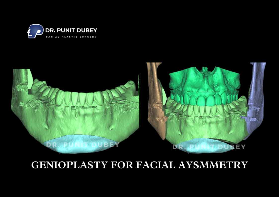 Genioplasty in Delhi by Dr. Punit Dubey, reshaping the chin for improved facial balance and symmetry.