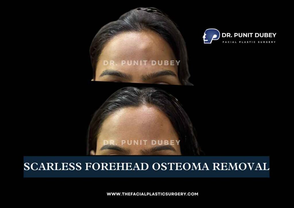 Osteoma Forehead Treatment In Delhi By Dr. Punit Dubey