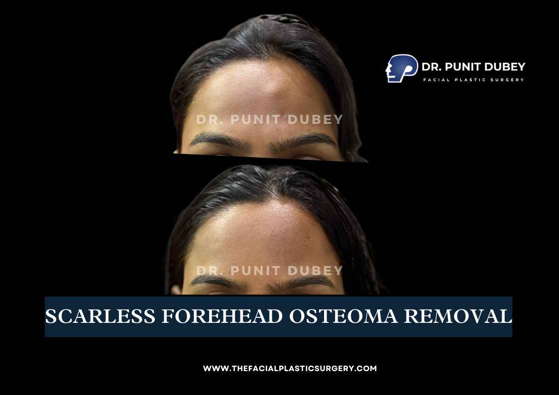 Forehead Osteoma Removal Before and After in India by Dr. Punit Dubey
