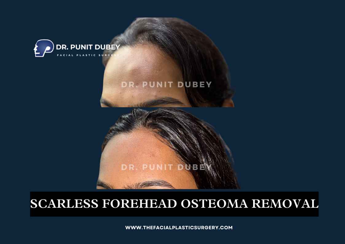 Osteoma Removal Cost in India by Dr. Punit Dubey - Affordable Forehead Surgery