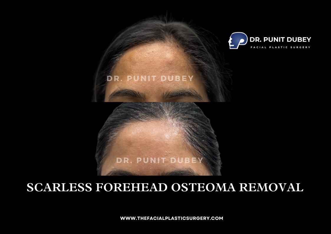 Osteoma Treatment in India by Dr. Punit Dubey - Smooth Forehead Contouring