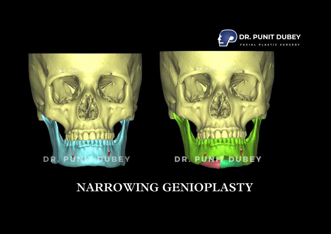 Chin reduction surgery in India by Dr. Punit Dubey, improving facial balance by reducing chin size.