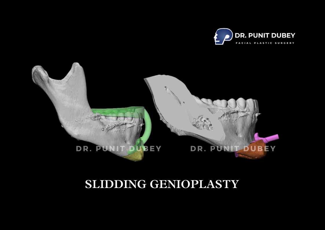 Sliding Genioplasty Before and After in India by Dr. Punit Dubey