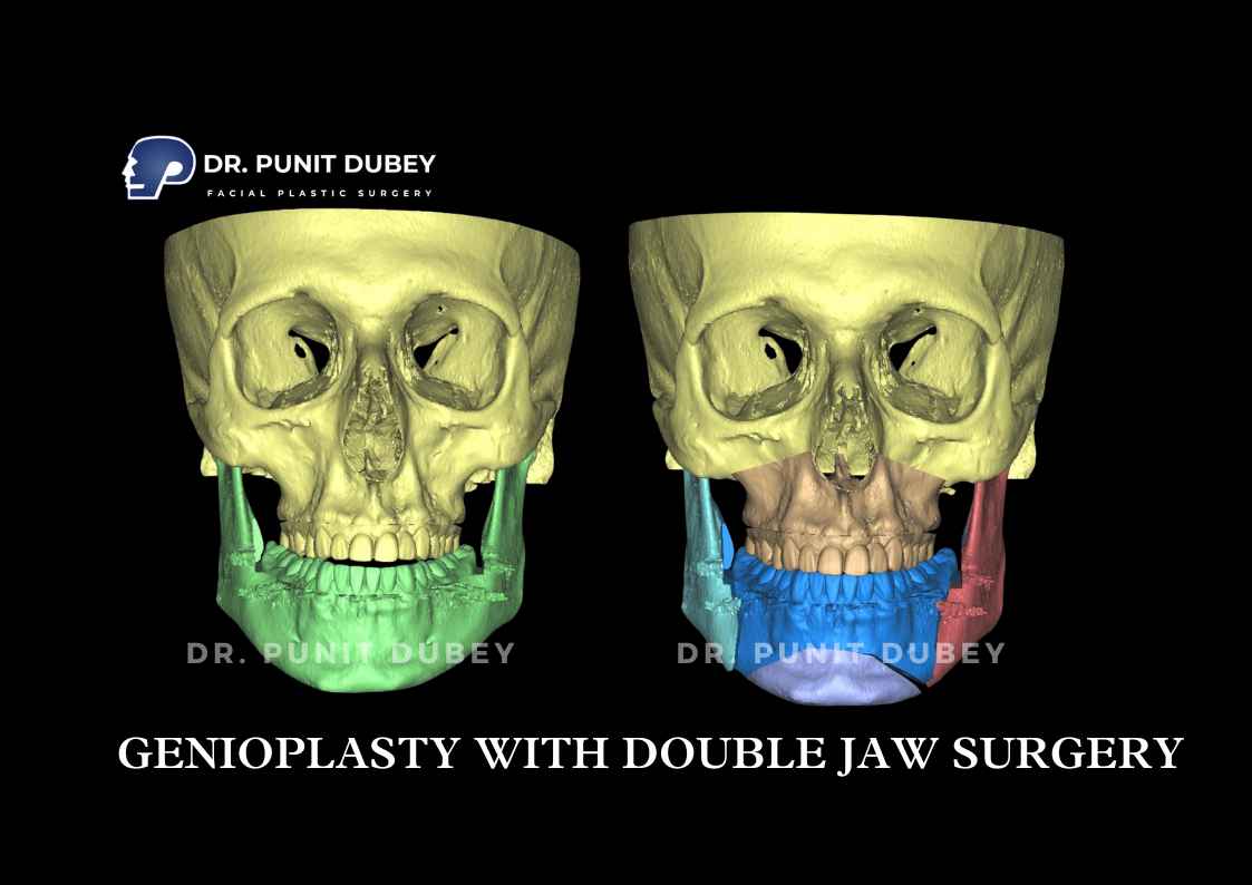 Corrective Jaw Surgery Before and After in Delhi by Dr. Punit Dubey