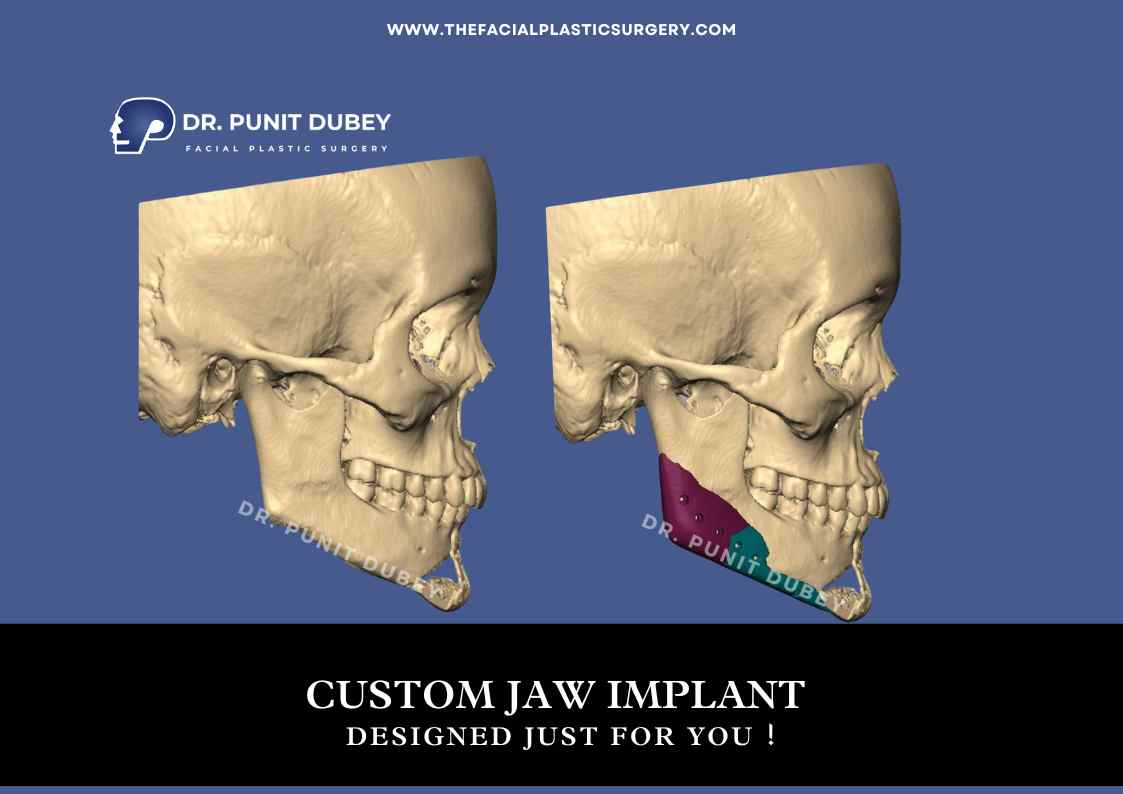 Custom Jaw Implant Before and After in India by Dr. Punit Dubey