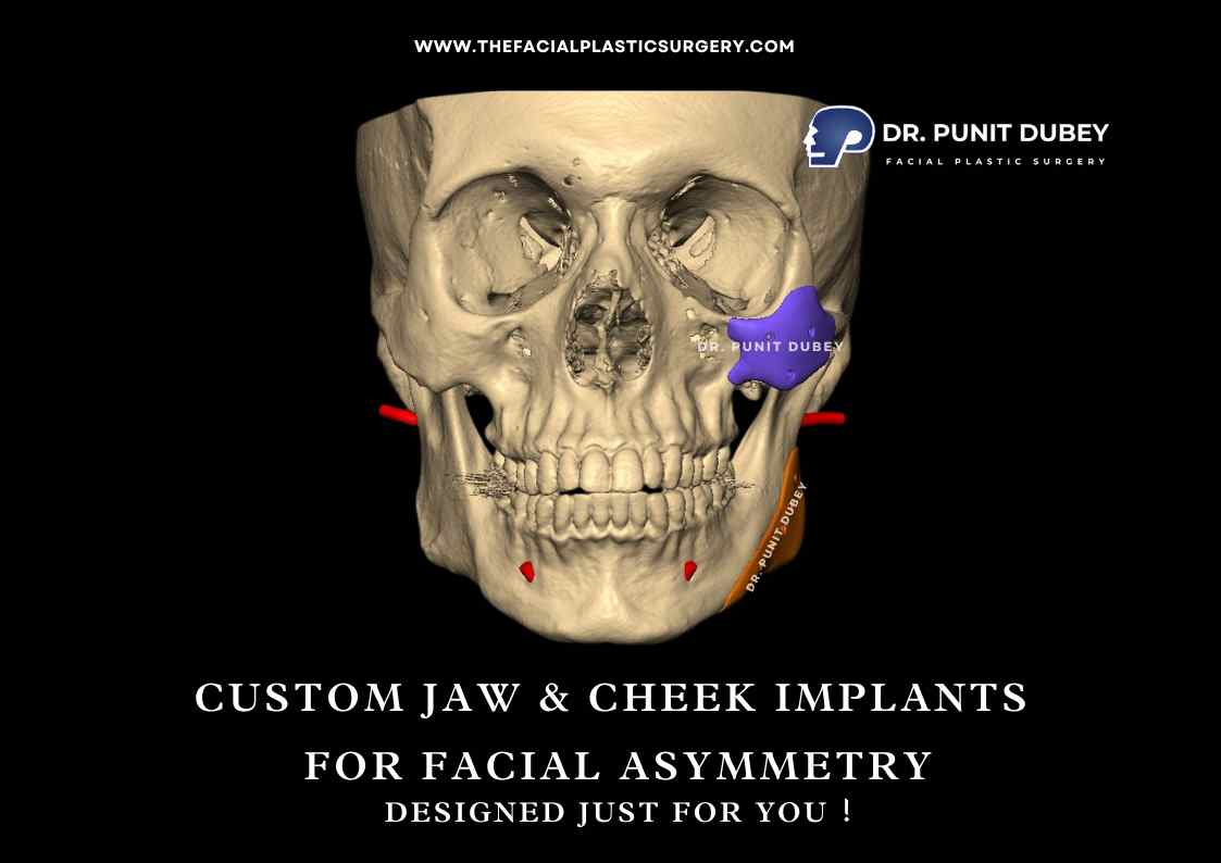 Custom Jaw Implant Surgery in Delhi by Dr. Punit Dubey