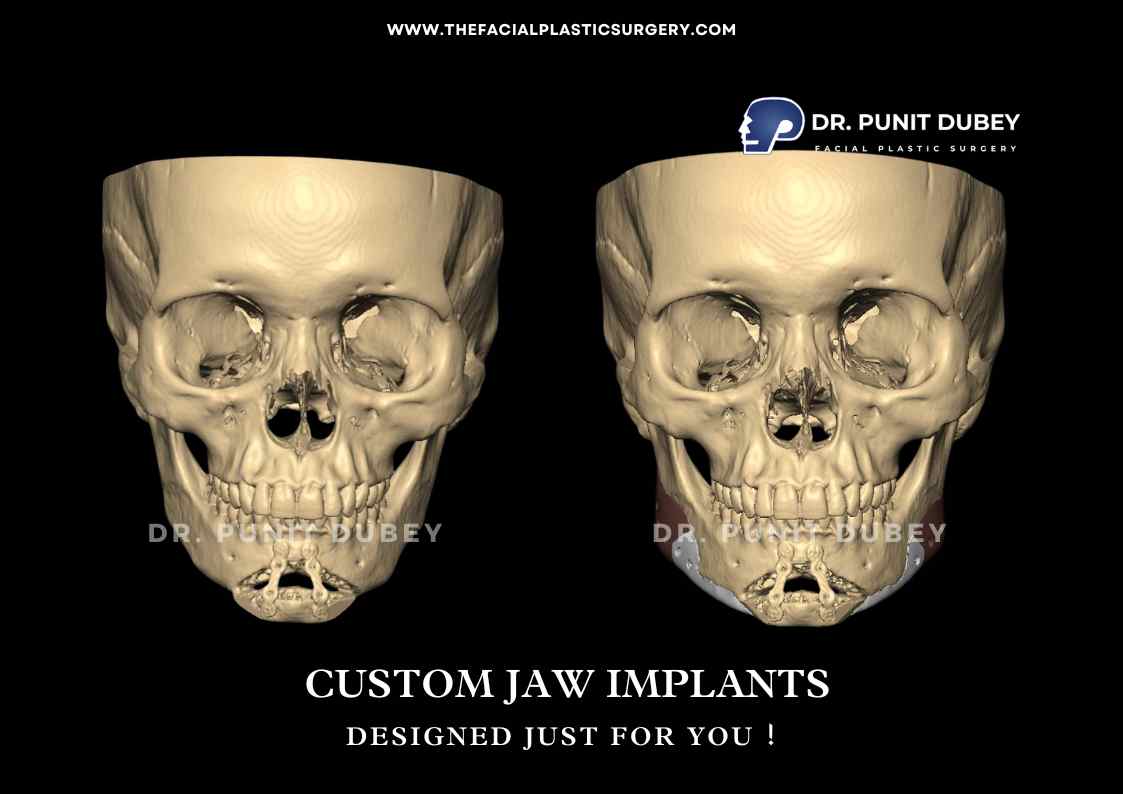 Custom Jaw Implants Before and After in Delhi by Dr. Punit Dubey