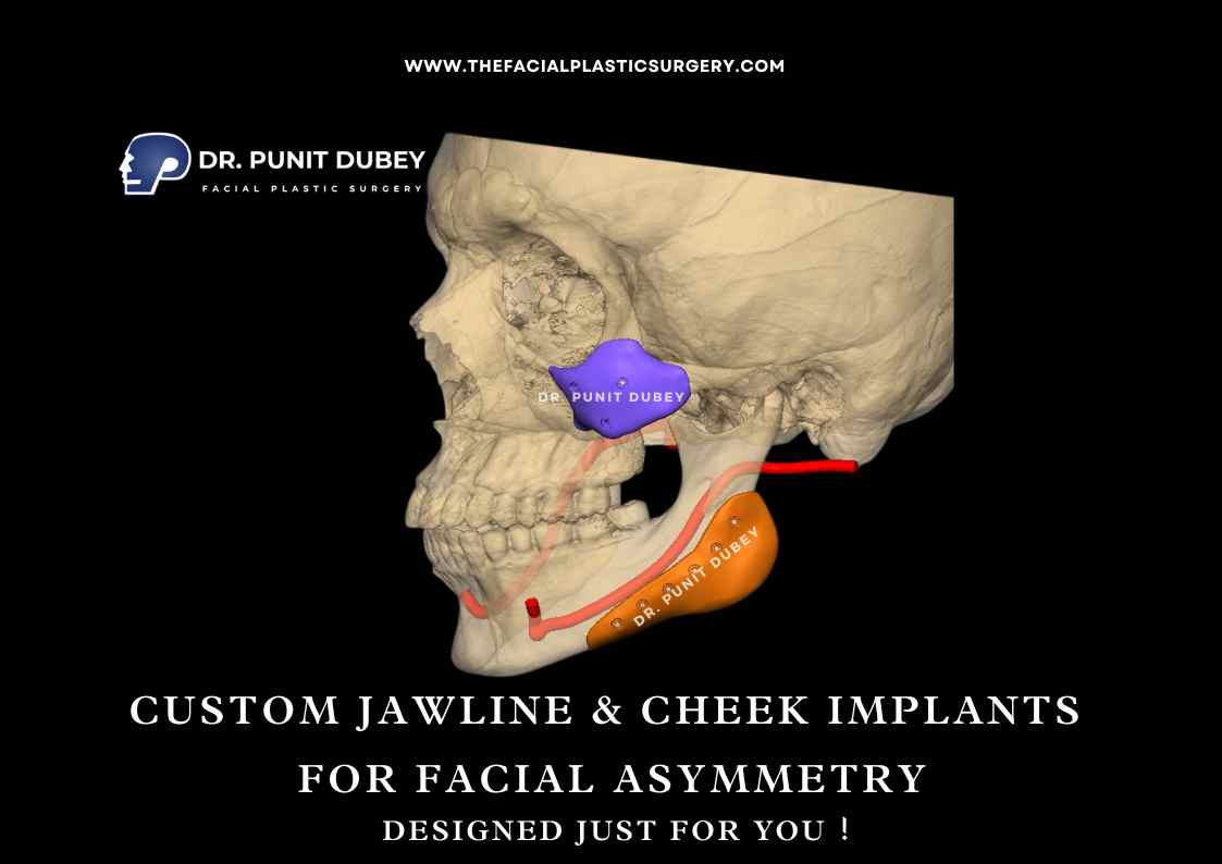 Custom Jaw Implants in India by Dr. Punit Dubey