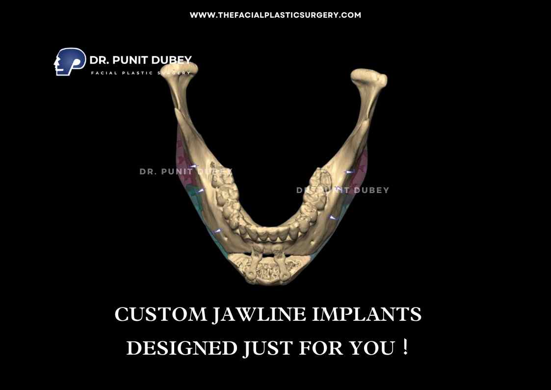 Custom Jawline Implant in India by Dr. Punit Dubey