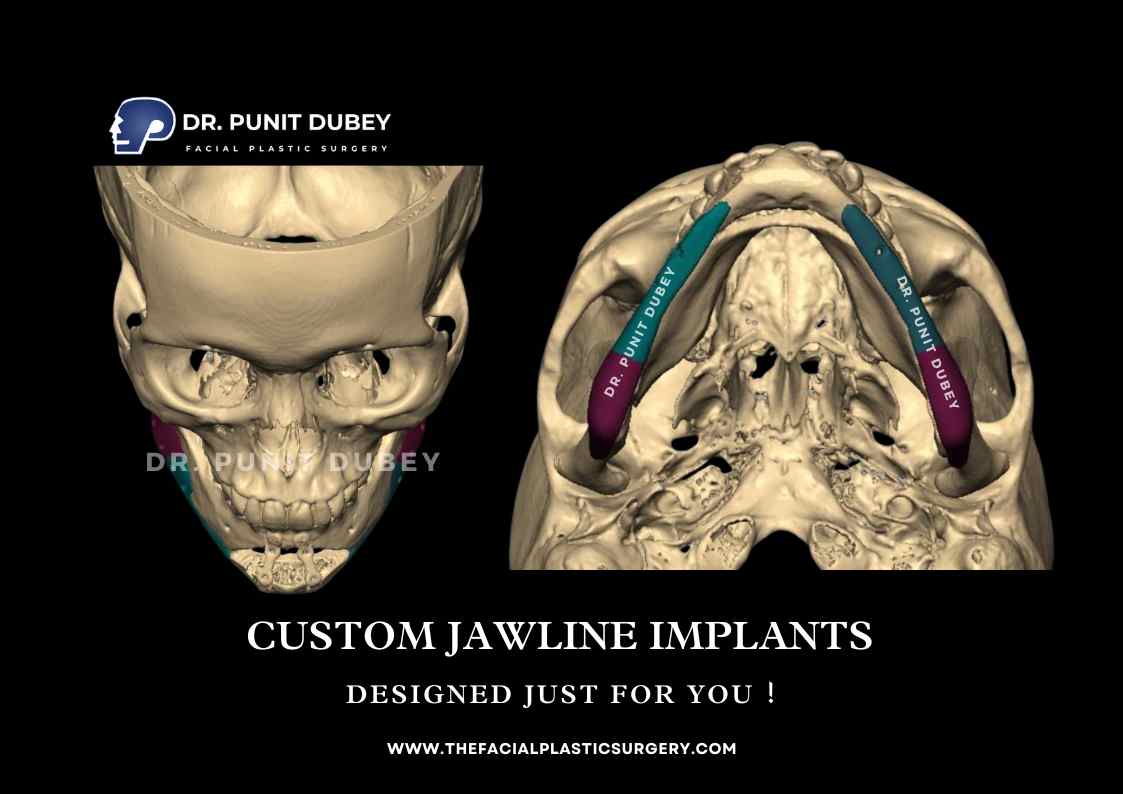 Custom Jawline Implants in India by Dr. Punit Dubey