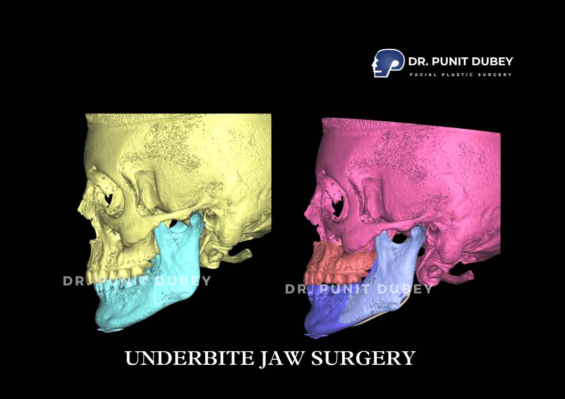 Double Jaw Surgery Before and After in Delhi by Dr. Punit Dubey