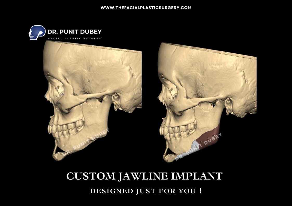 Jaw Implant Before and After in India by Dr. Punit Dubey