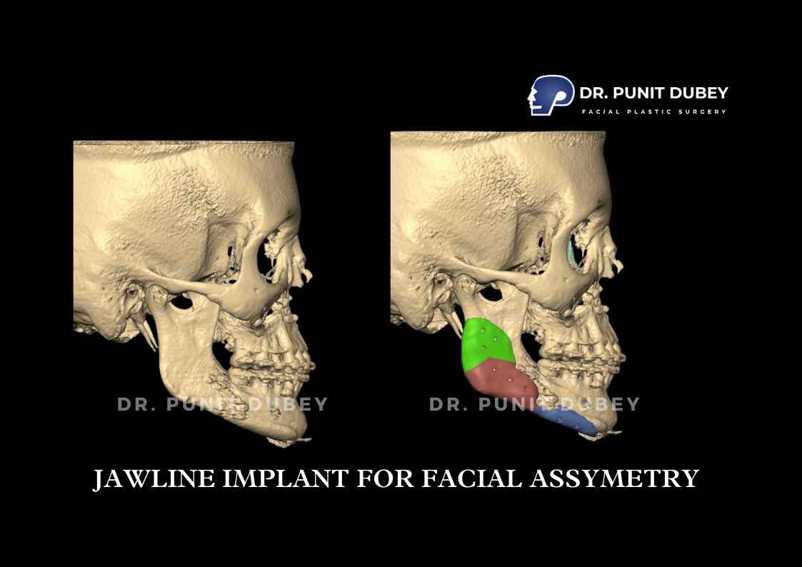 Jaw Implant Before and After in Delhi by Dr. Punit Dubey