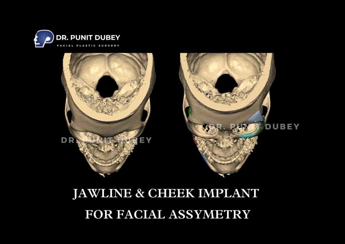 Jaw Implant Surgery in Delhi by Dr. Punit Dubey