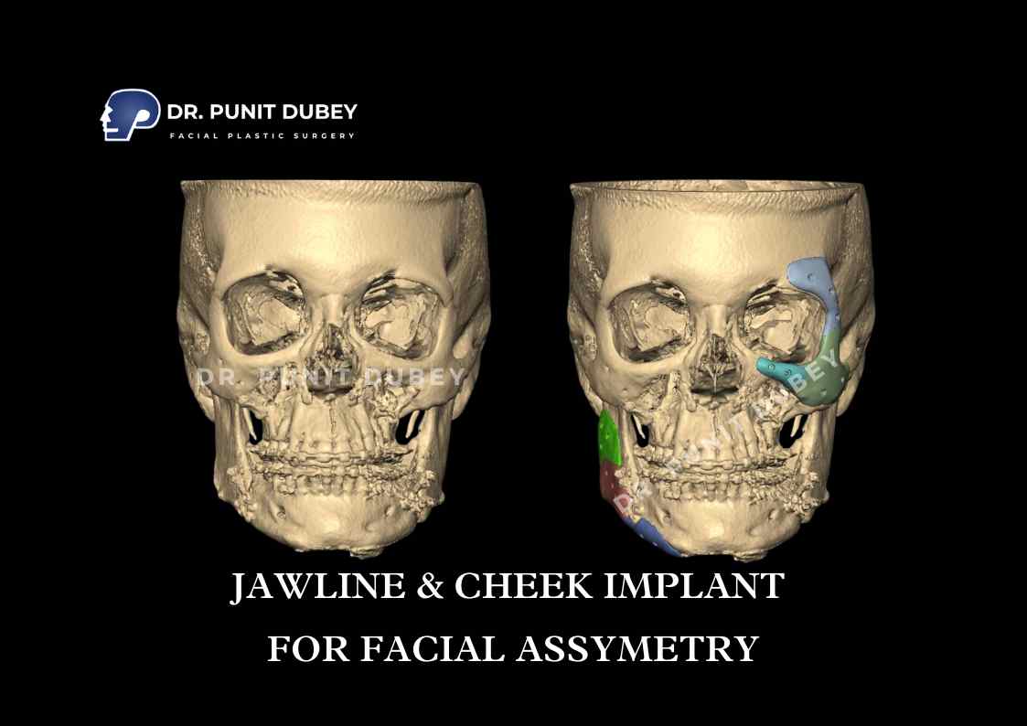 Jaw Implants Before and After in Delhi by Dr. Punit Dubey