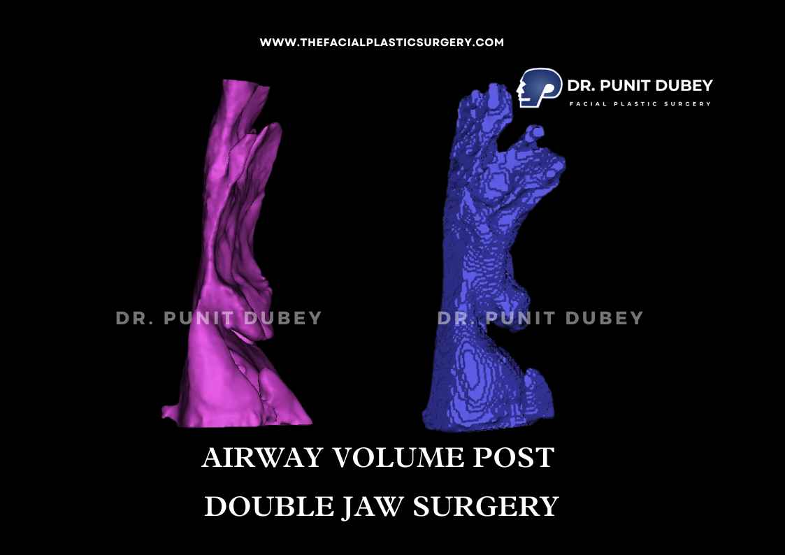 Jaw Surgery for Obstructive Sleep Apnea Treatment in Delhi by Dr. Punit Dubey