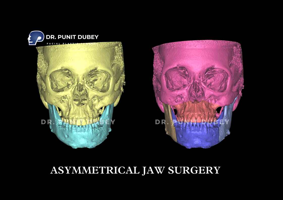 Orthognathic Surgery Before and After in Delhi by Dr. Punit Dubey