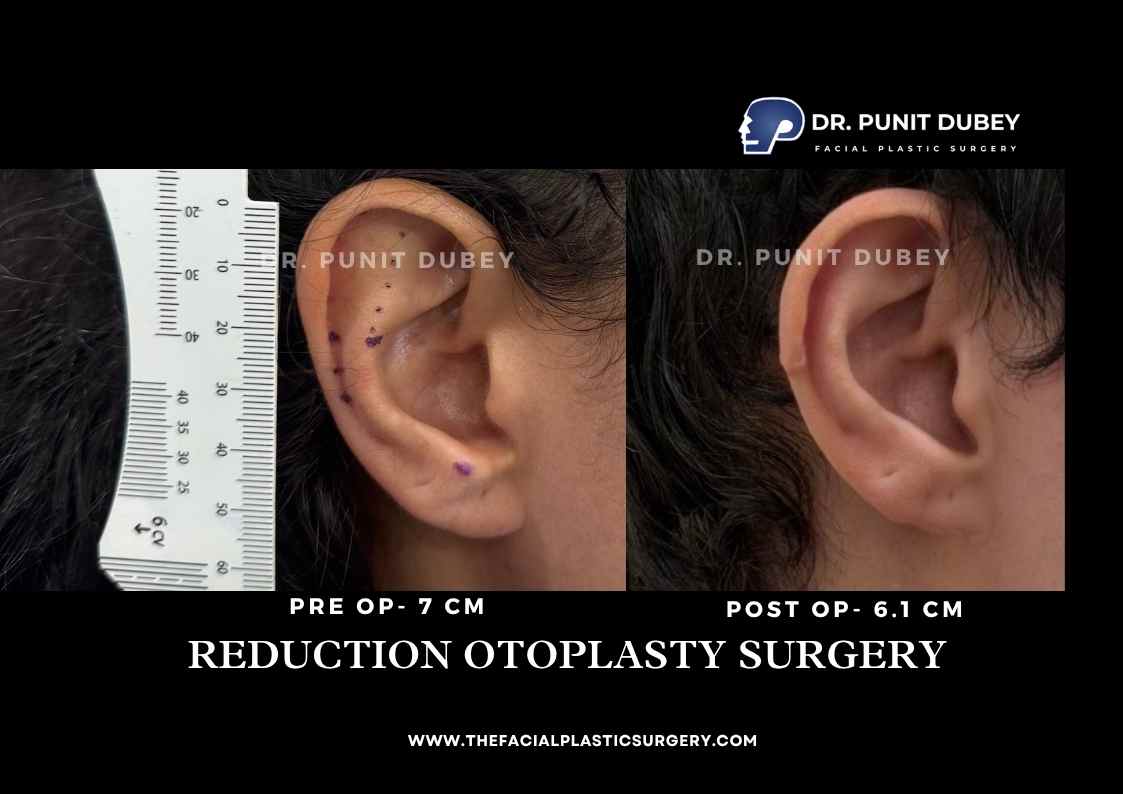 Otoplasty Before and After in Delhi by Dr. Punit Dubey
