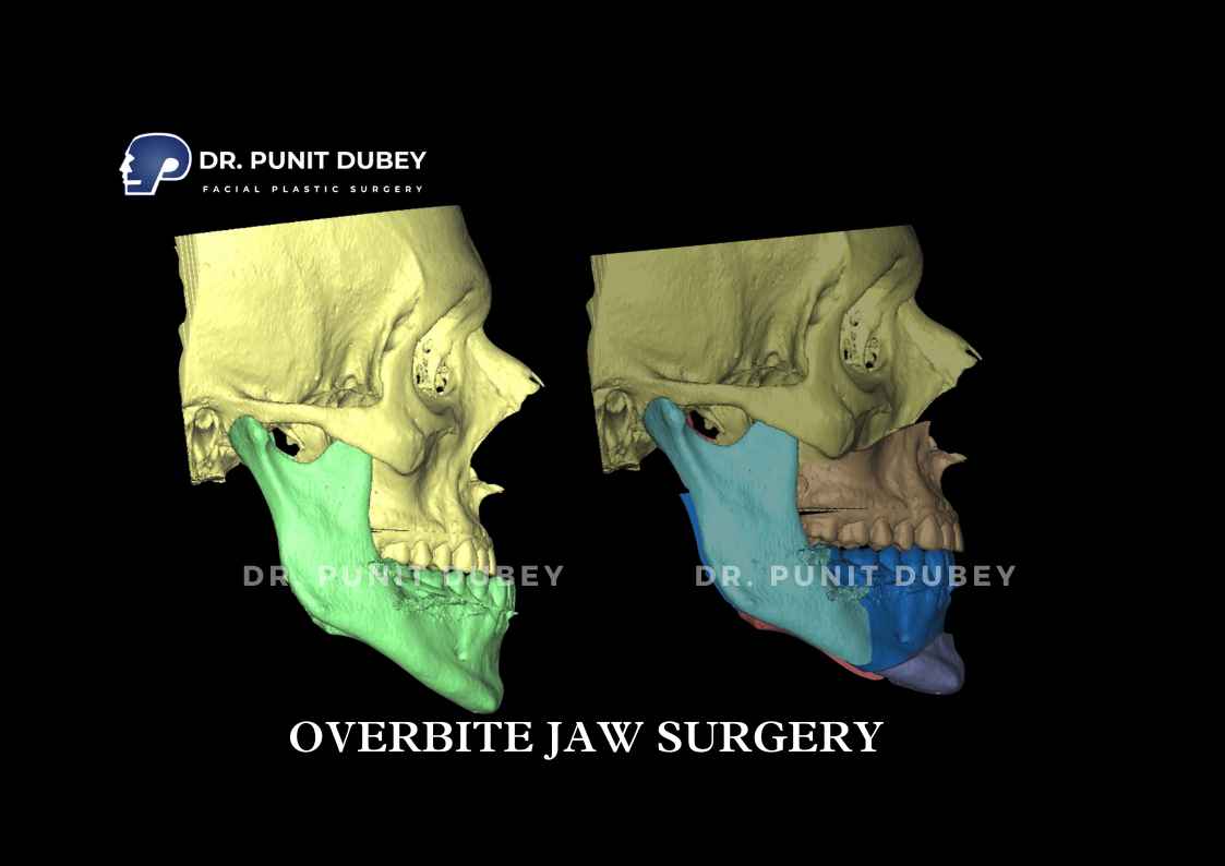 Overbite Jaw Surgery Before and After in Delhi by Dr. Punit Dubey