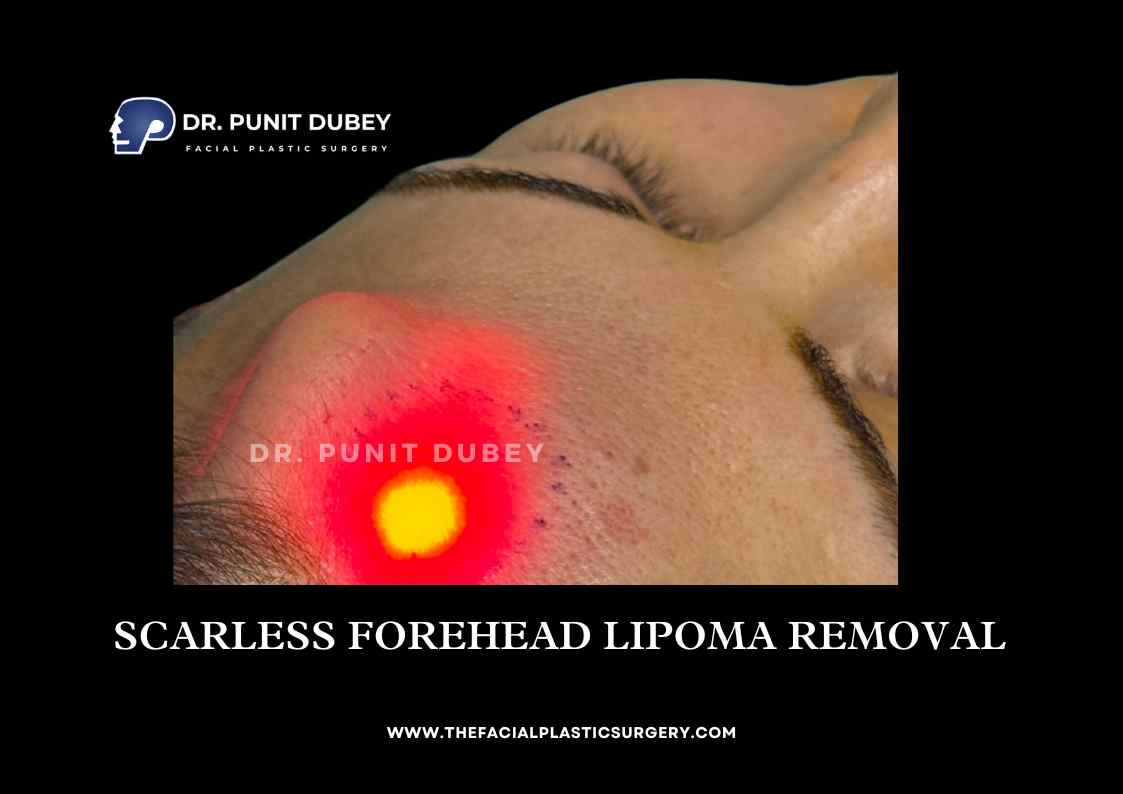 Scarless Forehead Lipoma Removal in Delhi by Dr. Punit Dubey