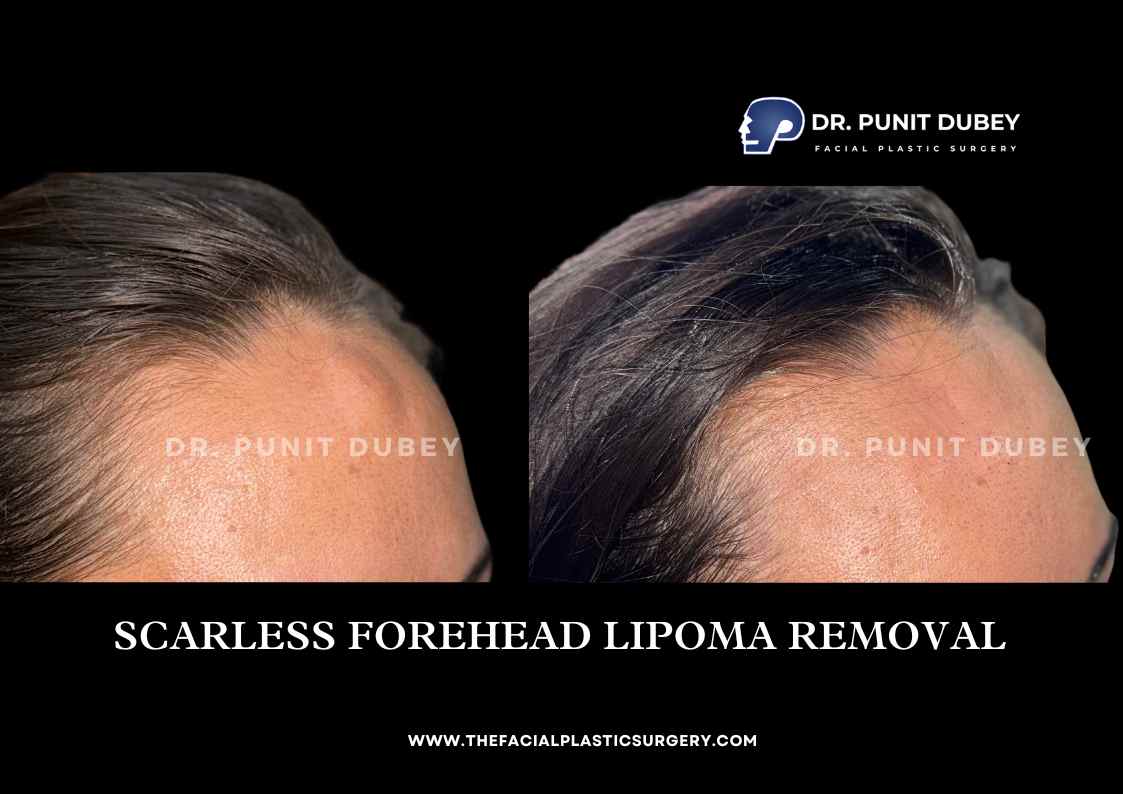 Scarless Lipoma Removal Before and After in Delhi by Dr. Punit Dubey
