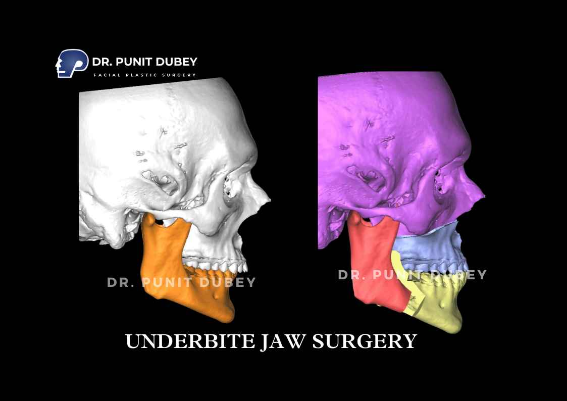 Underbite Jaw Surgery Before and After in Delhi by Dr. Punit Dubey